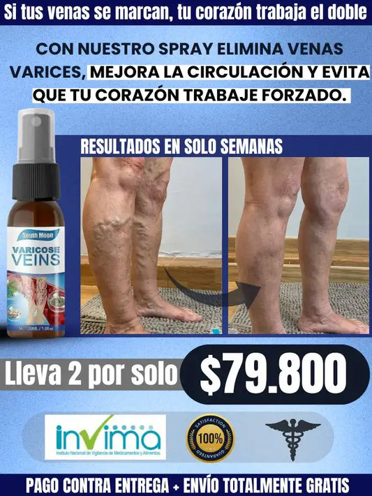 varicose veins